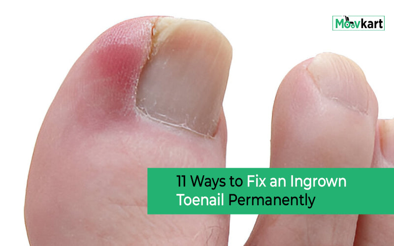 11 Ways to Fix an Ingrown Toenail Permanently